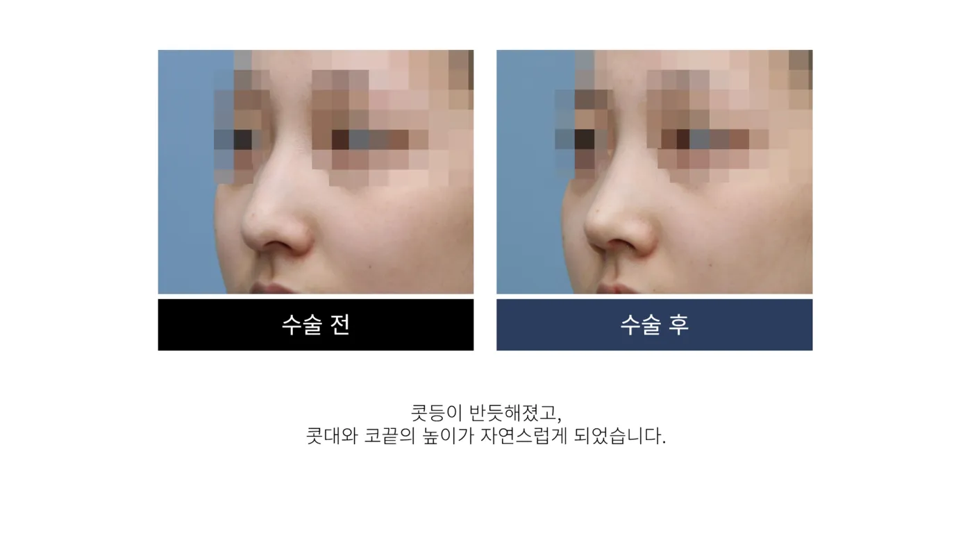 첫 코 성형 - 리숨