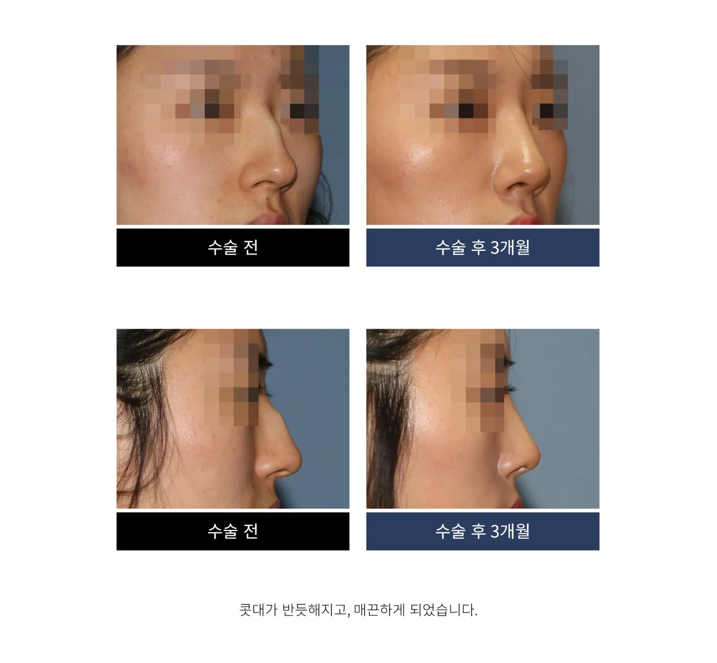 첫 코 성형 - 리숨